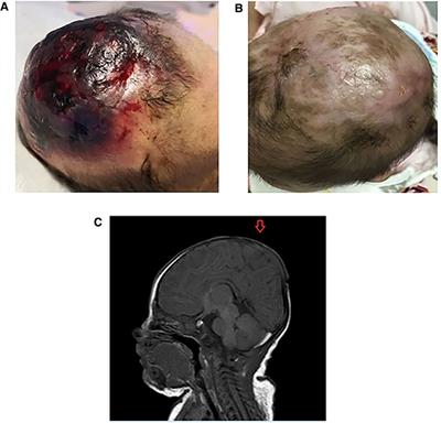 Case report: Recombinant human epidermal growth factor gel plus kangfuxin solution in the treatment of aplasia cutis congenita in a case with Adams–Oliver syndrome